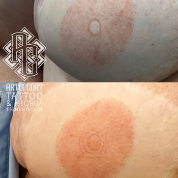Areola done 7-21-25